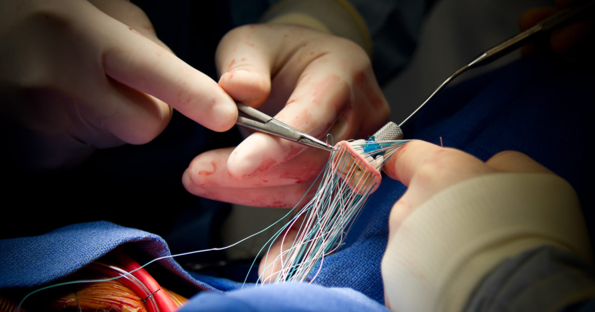 Heart Surgery Aortic Valve Replacement